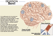 demencia