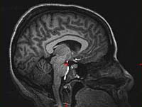 Imagen del cerebro humano