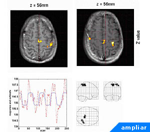 Actividad cerebral a travs de la tcnica de Imgen de Resonancia Magntica Funcional