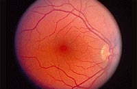 Retina a travs de un oftalmoscopio