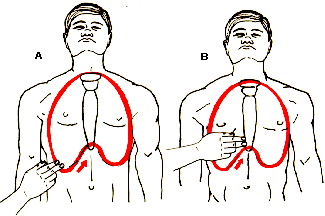 Compresin Cardaca Externa