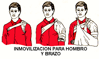 inmovilizacin hombro - brazo